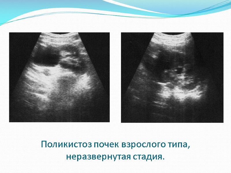 Поликистоз почек взрослого типа, неразвернутая стадия.